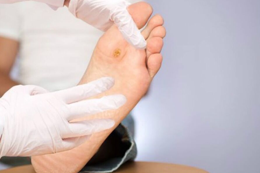 Diabetici - Grave complicazione del diabete